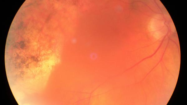 Atrophie nach Chorioretinitis bei Borreliose