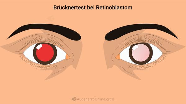 Retinoblastom