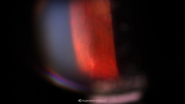 Periphlebitis retinae