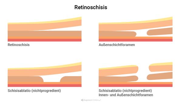 Retinoschisis - Einteilung