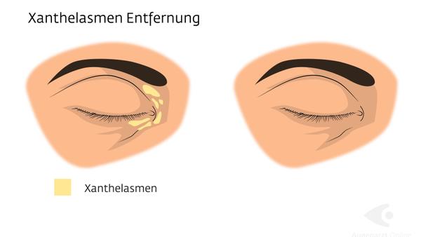 Xanthelasmen Gelbliche Lidveränderungen entfernen