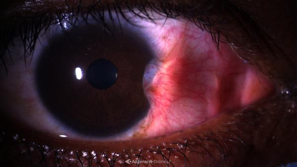 Pterygium