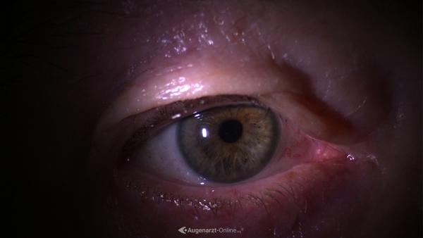 Dermatochalasis