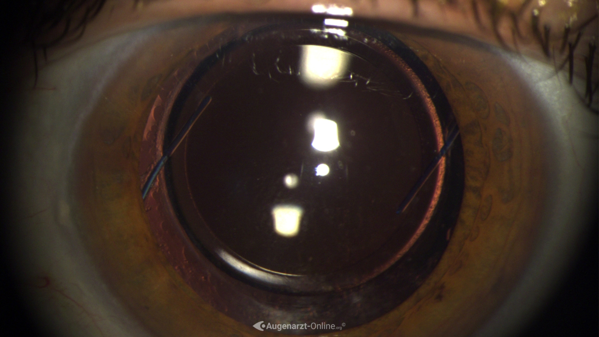 Dreitteilige Intraokularlinse