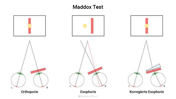 Maddox Rod Test
