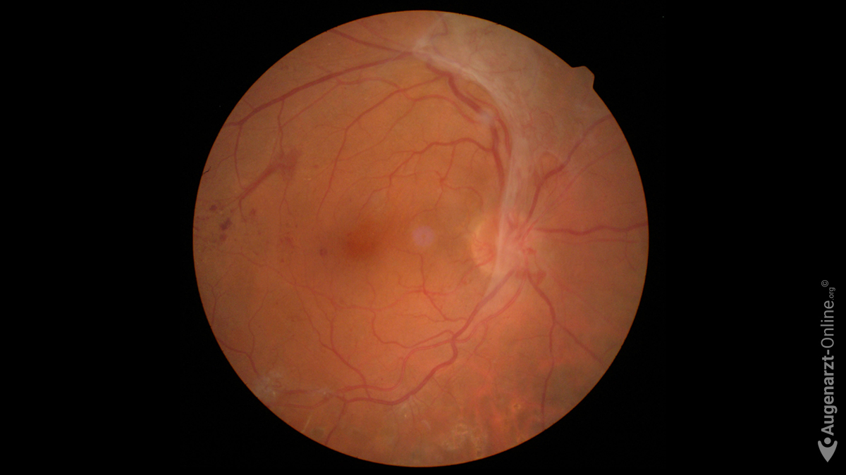 Proliferationssegel