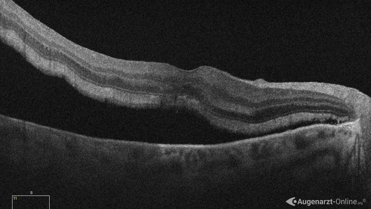 Ablatio retinae