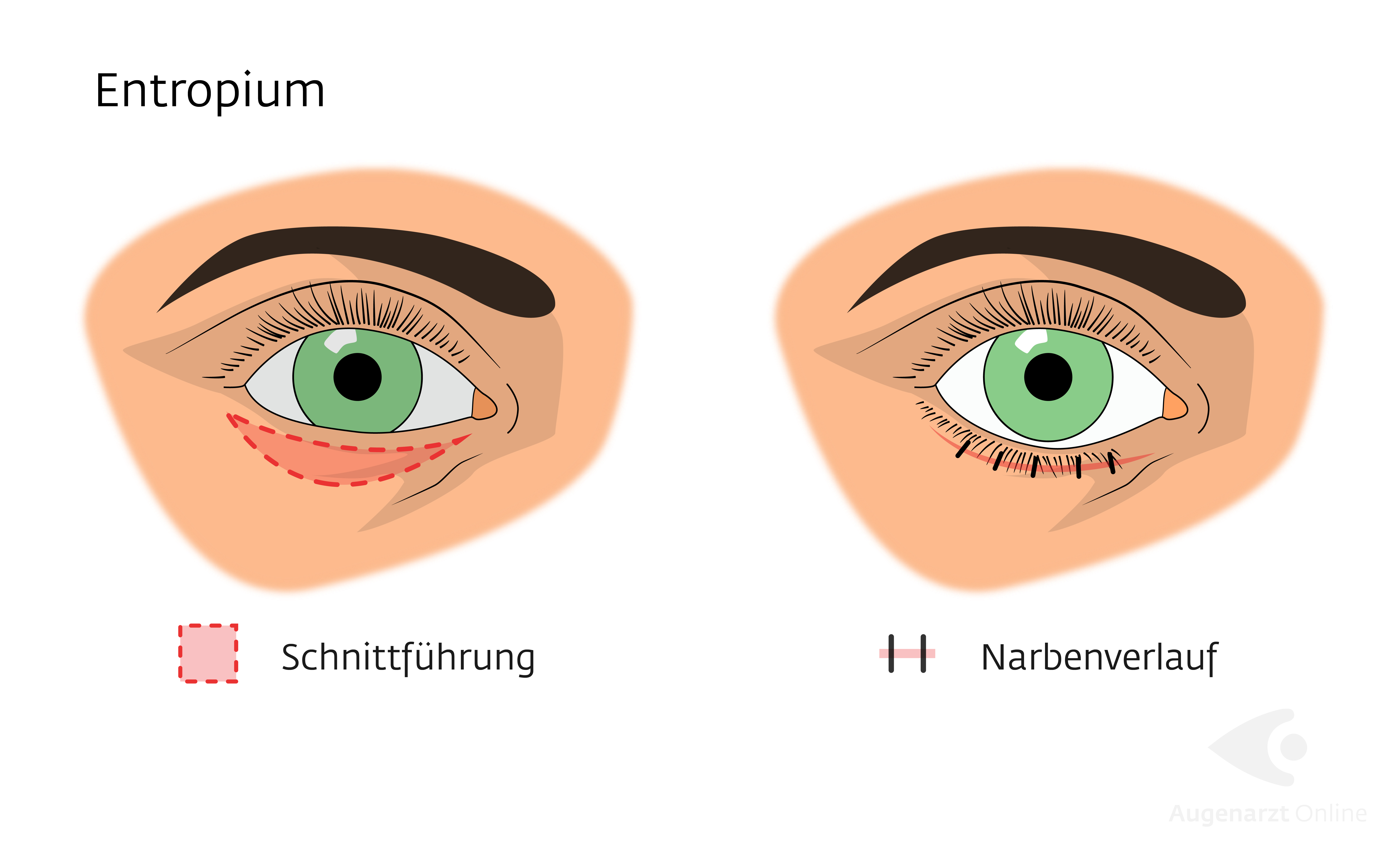 Entropium Einwärtsdrehung des Augenlids