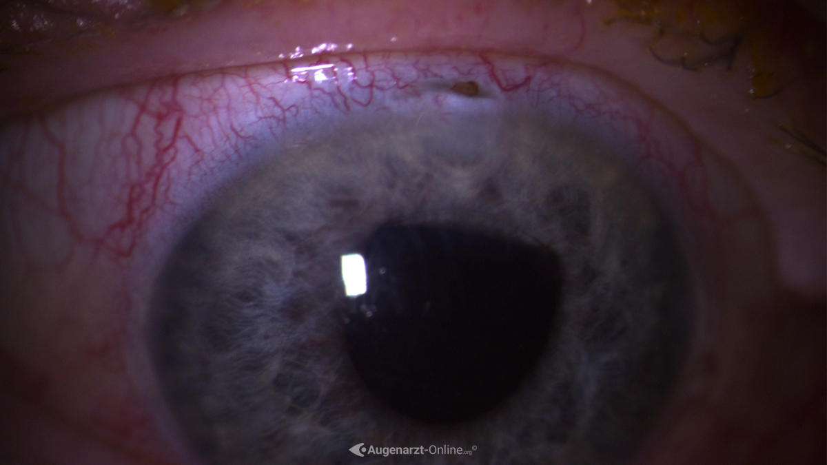 Irisprolaps