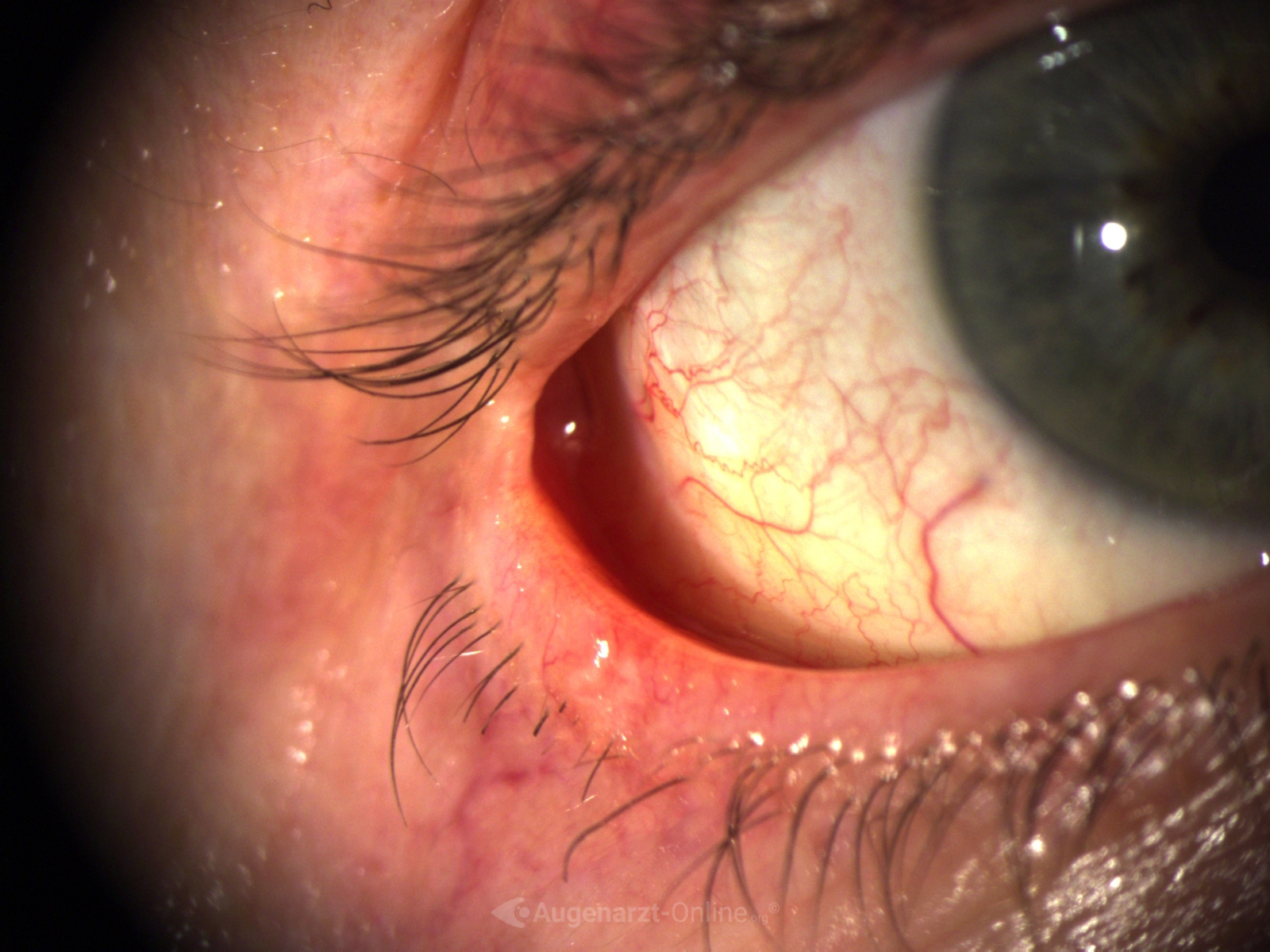 Medizinische Dokumentation: Basaliomexzision (Spaltlampenfoto).
