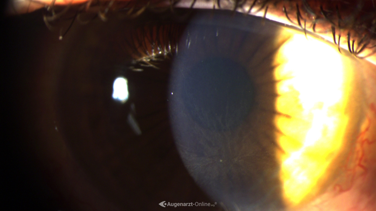 Cornea verticillata