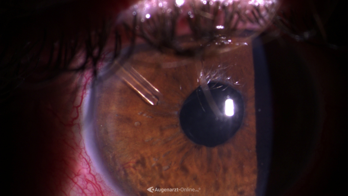 Ahmed Valve Implantat