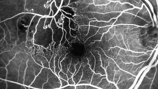 Ischämie Astvenenthrombose
