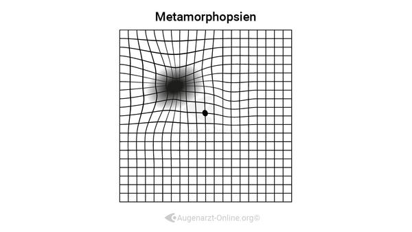 Metamorphopsien