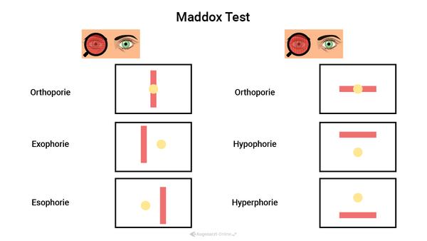 Maddox Rod Test