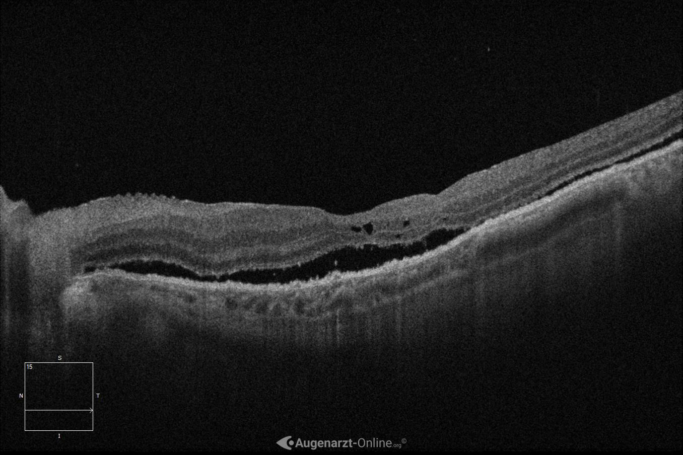 Amotio retinae