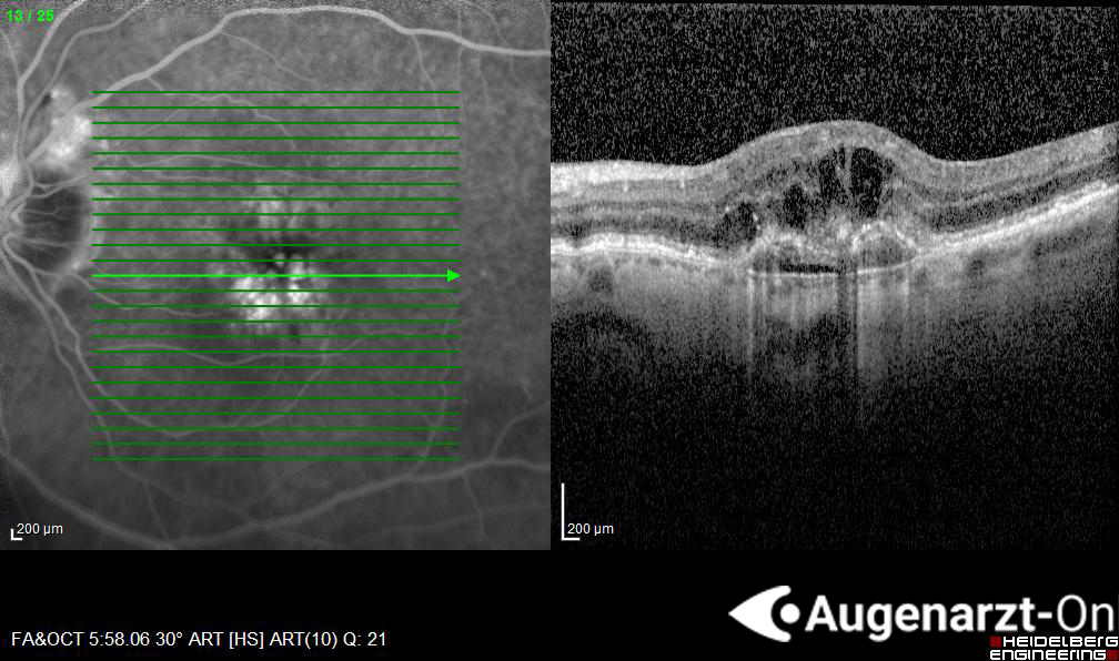 Exsudative AMD