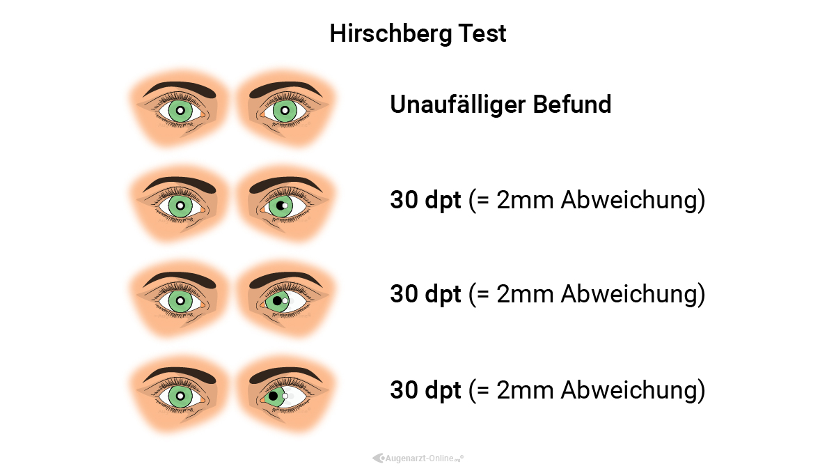 Hirschberg Test