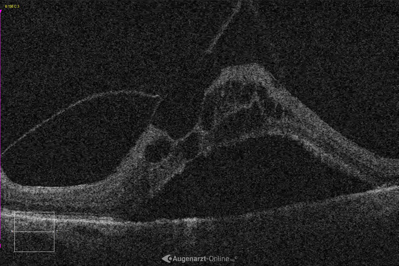 Ablatio retinae bei vitreomakulärer Traktion