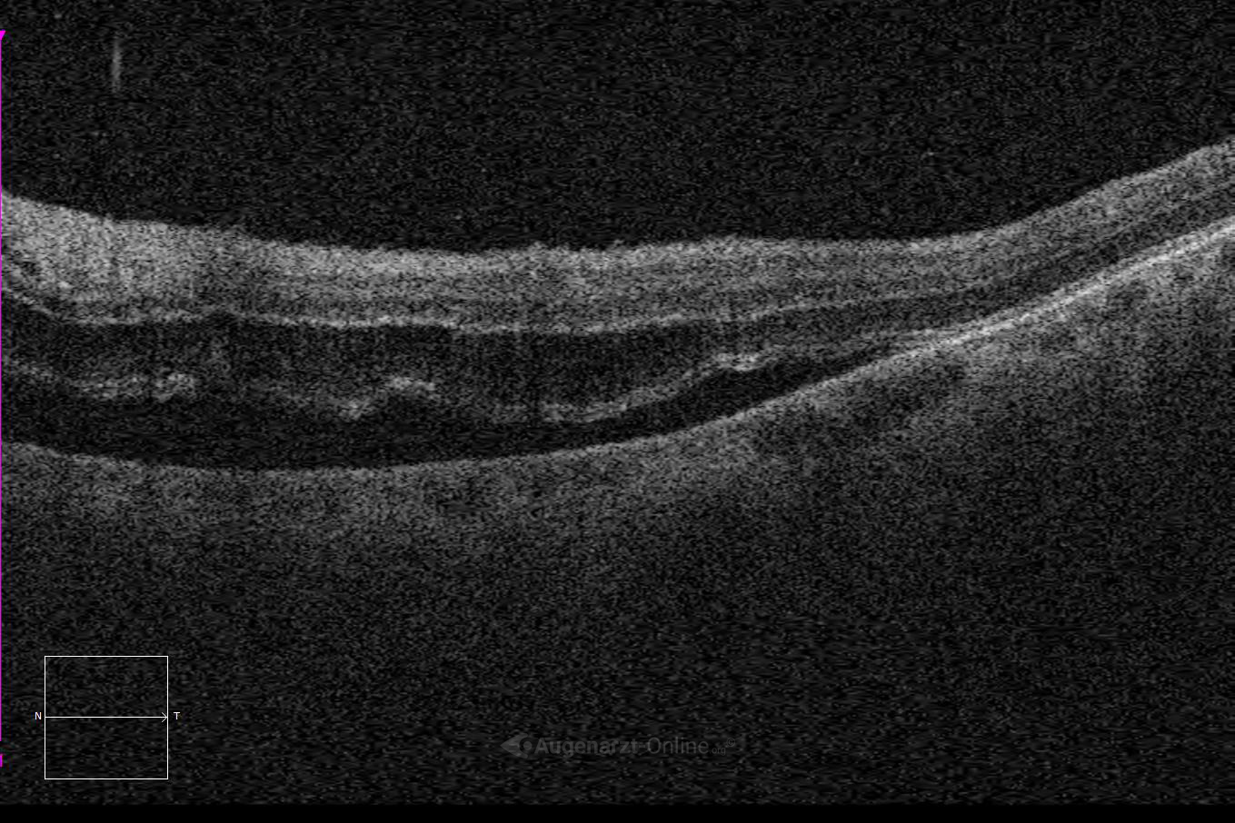 Ophthalmologisches oct des linken Auges mit Bezug zu Ablatio Retinae.
