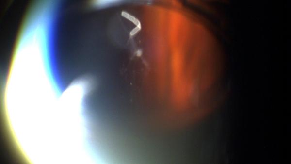 Dexamethason Implantat