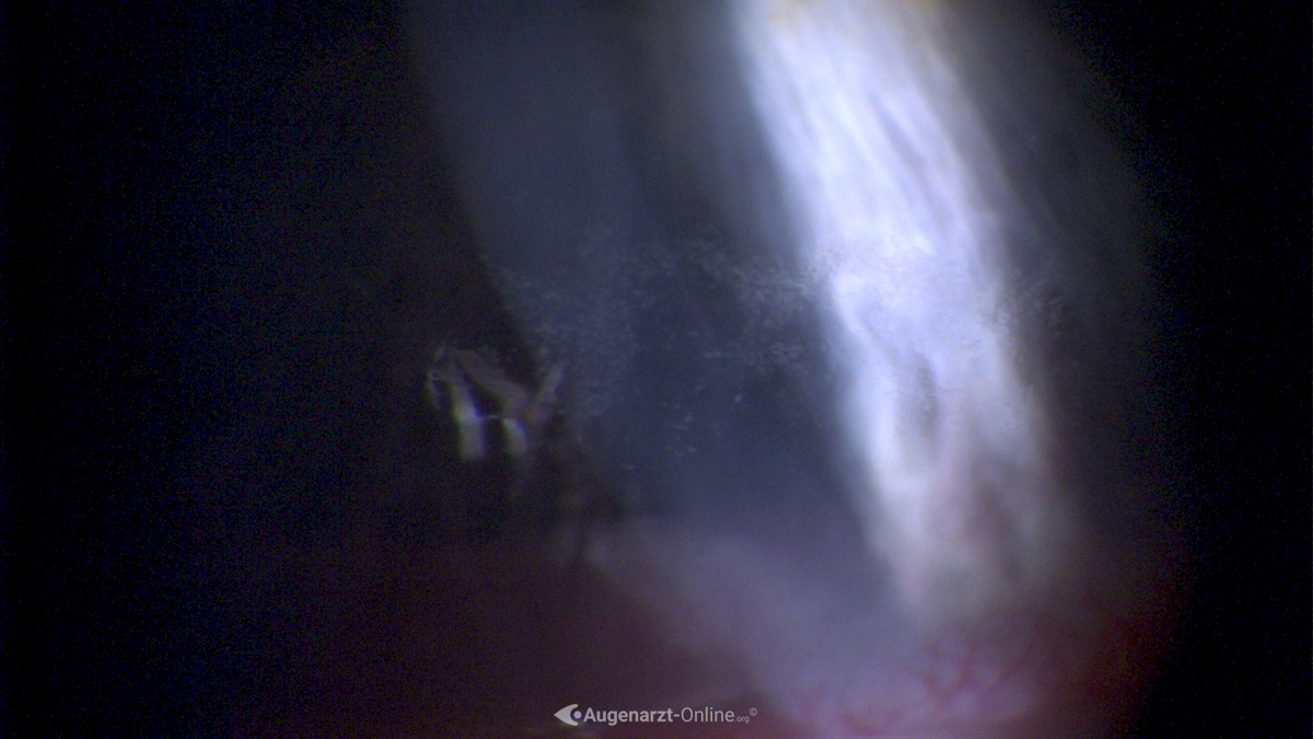 Trockenes Auge