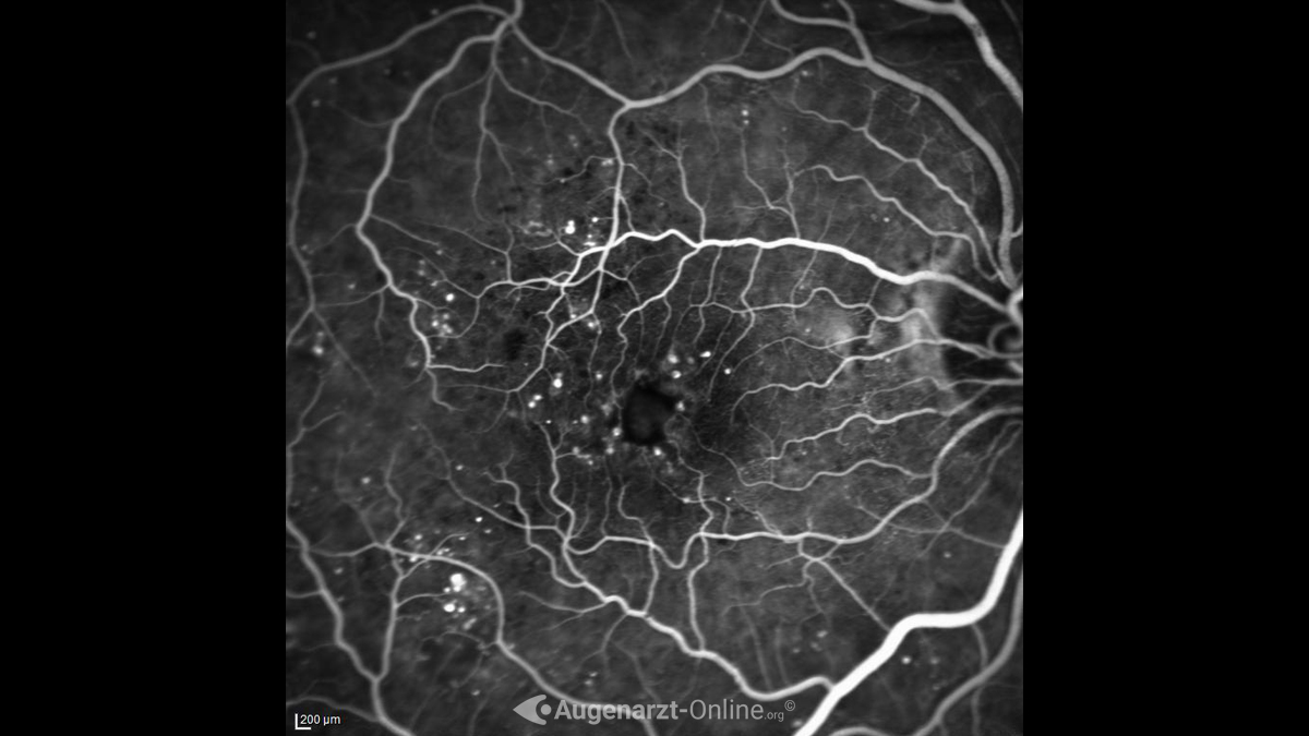 Diabetische Retinopathie