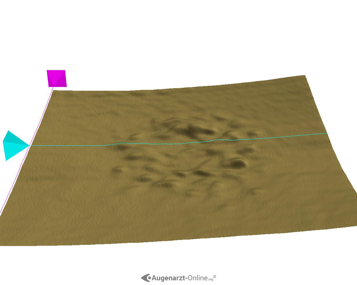 Altersbedingte Makuladegeneration