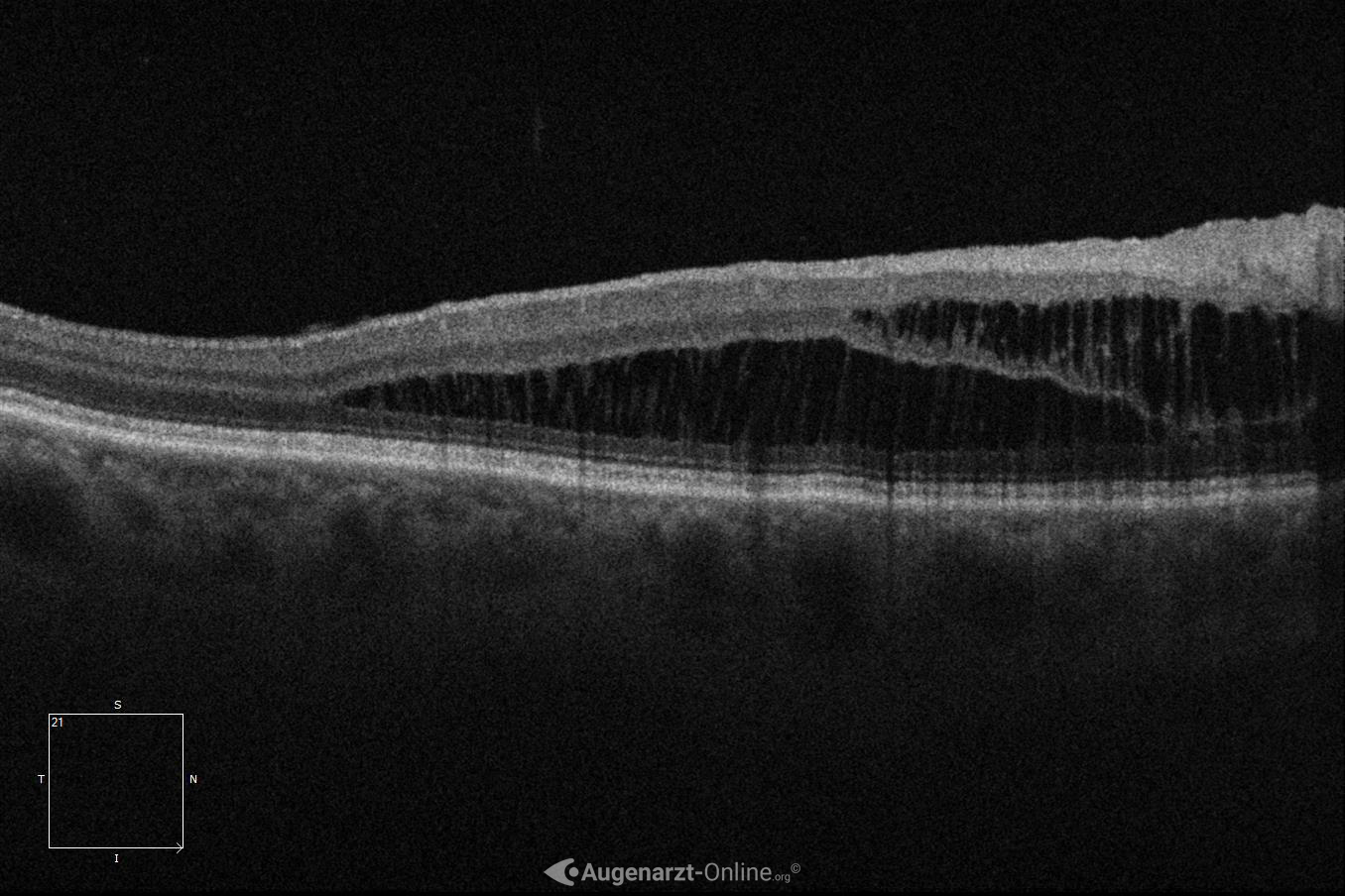 Retinoschisis