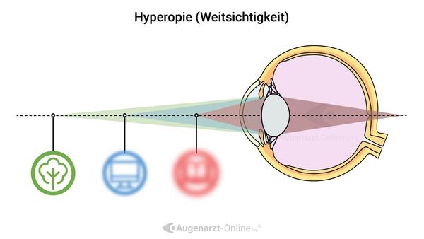 Weitsichtigkeit (Hyperopie) Erklärung