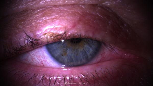 Ptosis