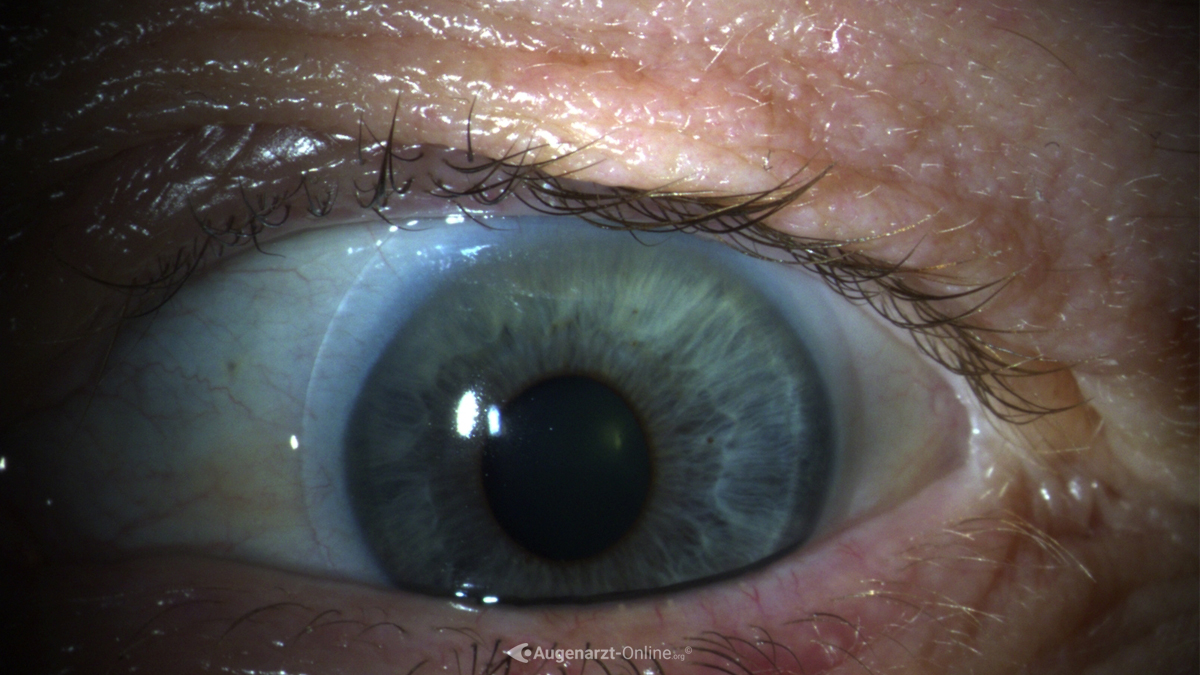 Kontaktlinse im Auge