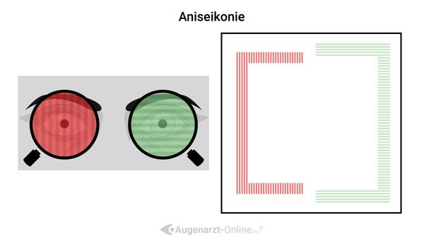 Aniseikonie