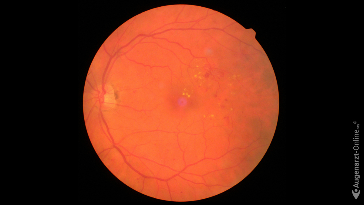 Diabetische Retinopathie