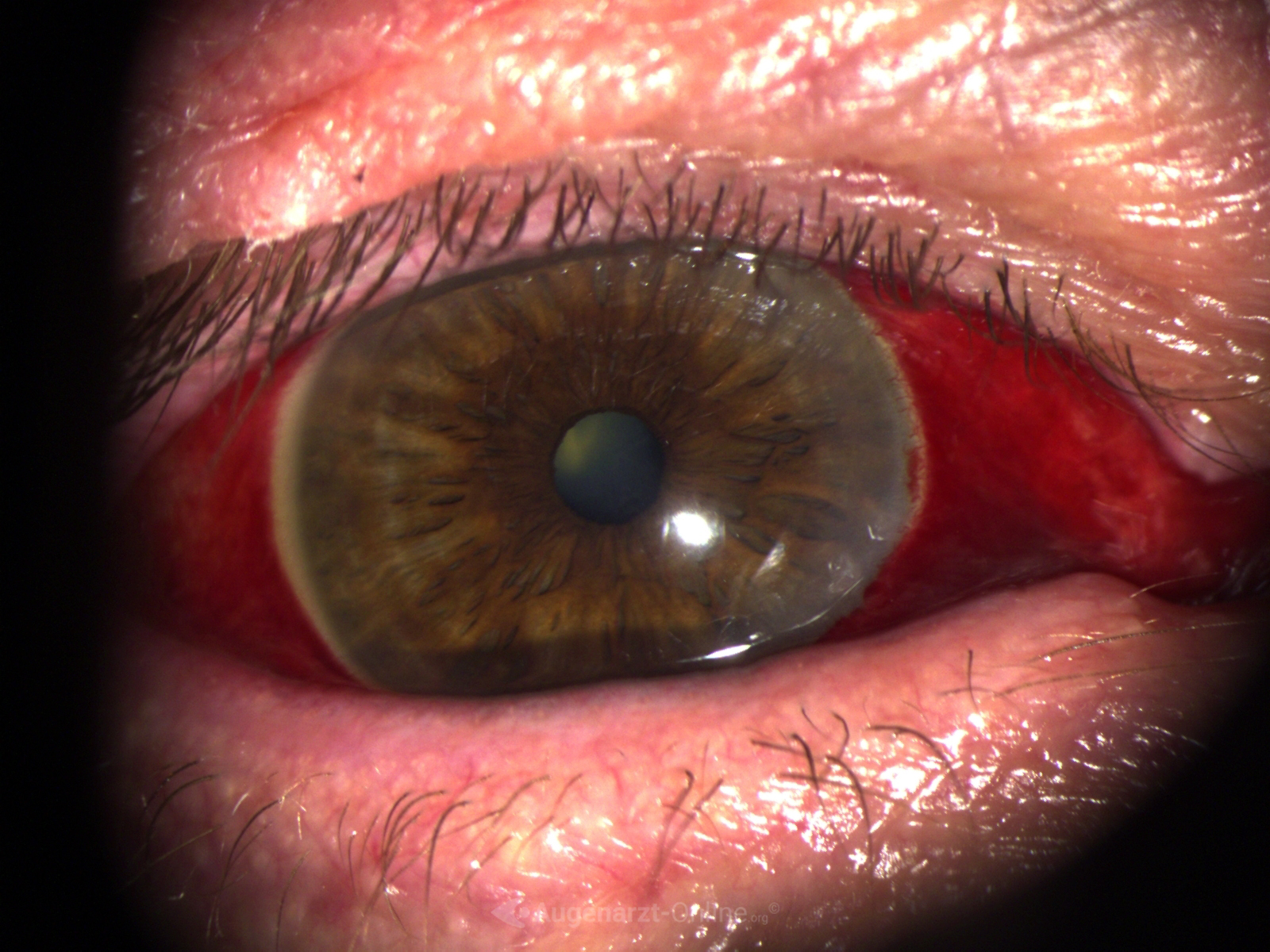 Medizinische Dokumentation: Hyposphagma (Spaltlampenfoto).