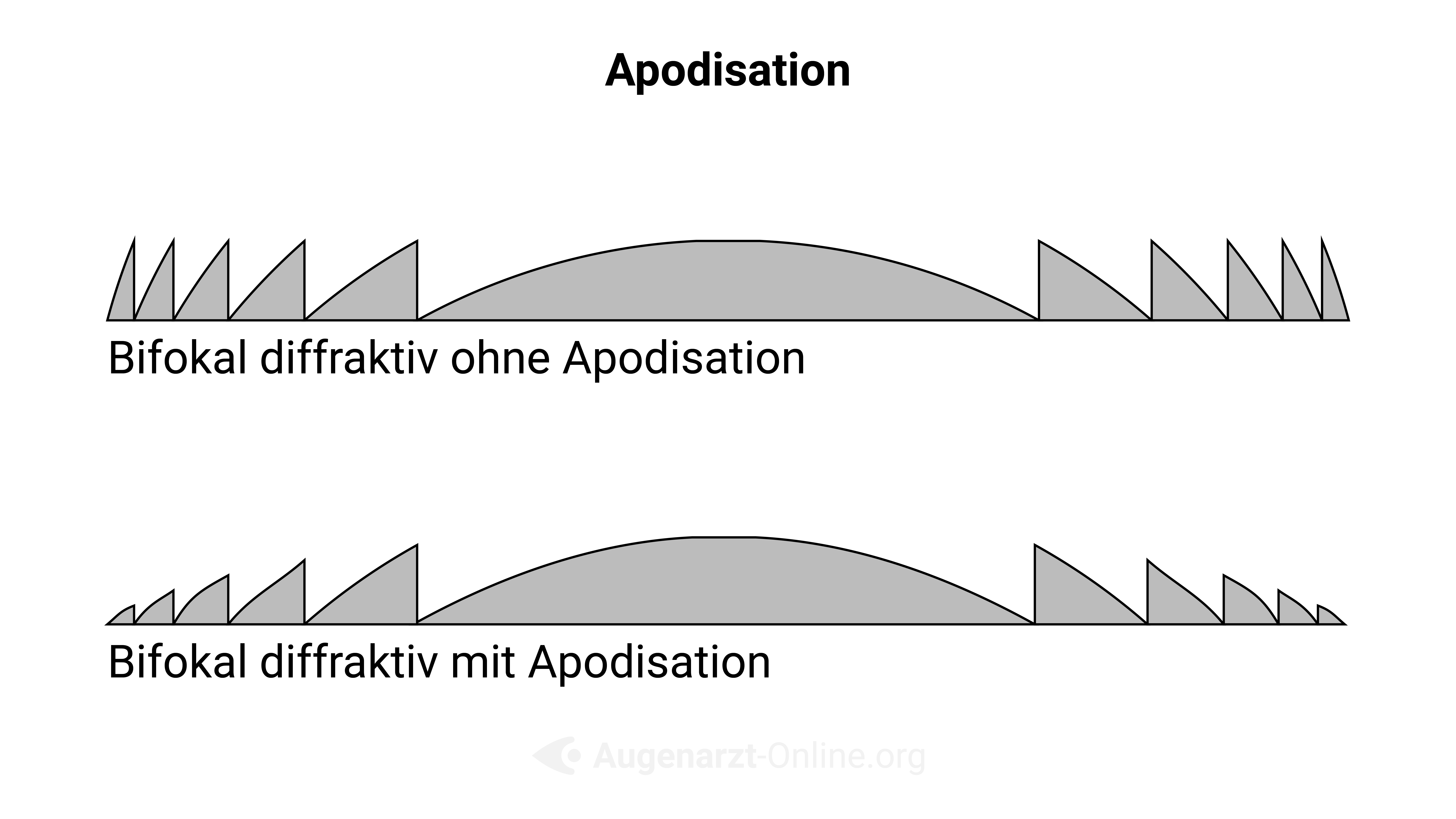 Apodisation (Multifokale IOL)