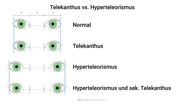 Telekanthus vs. Hypertelorismus