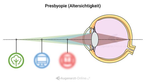 Altersichtigkeit (Presbyopie)