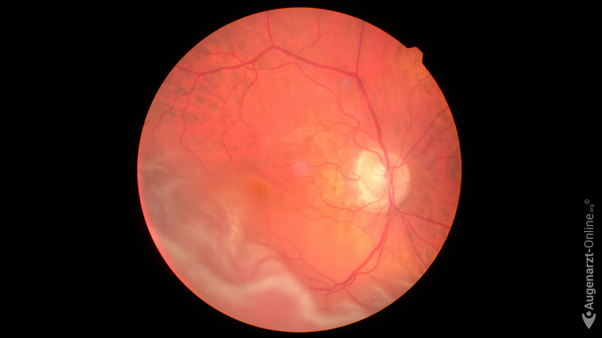 Ablatio retinae