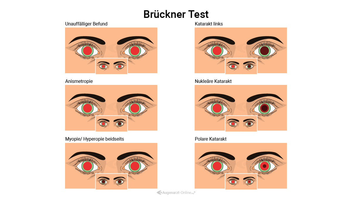 Brückner Test
