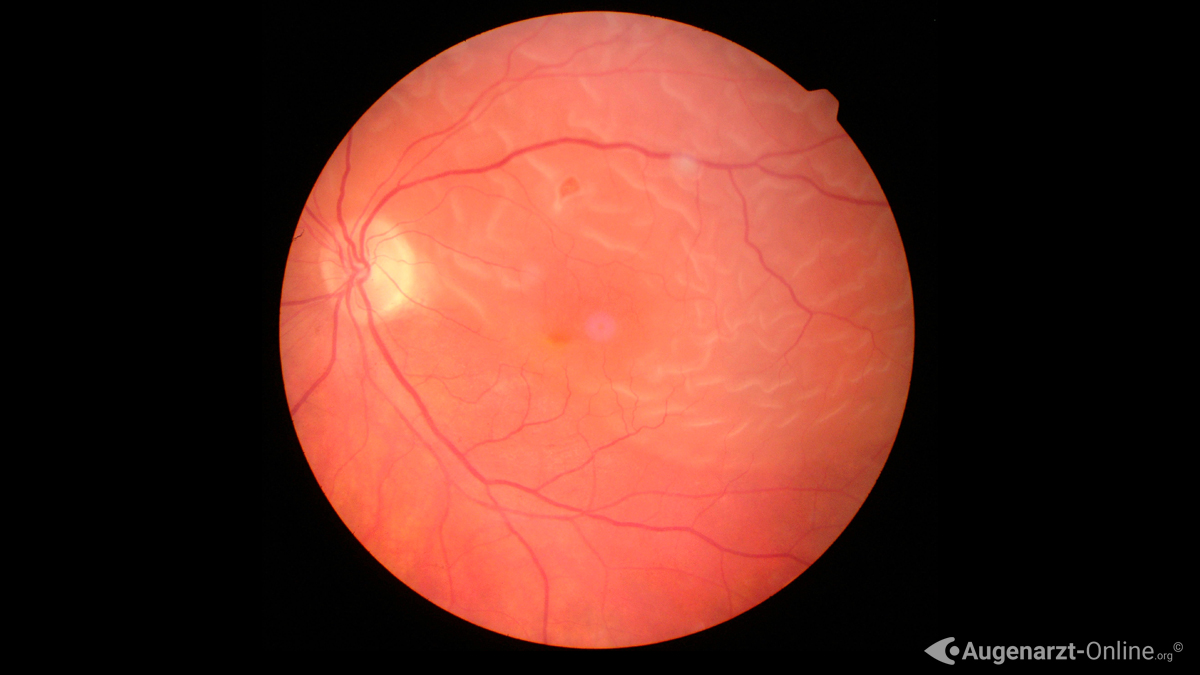 Ablatio retinae mit zentralem Defekt