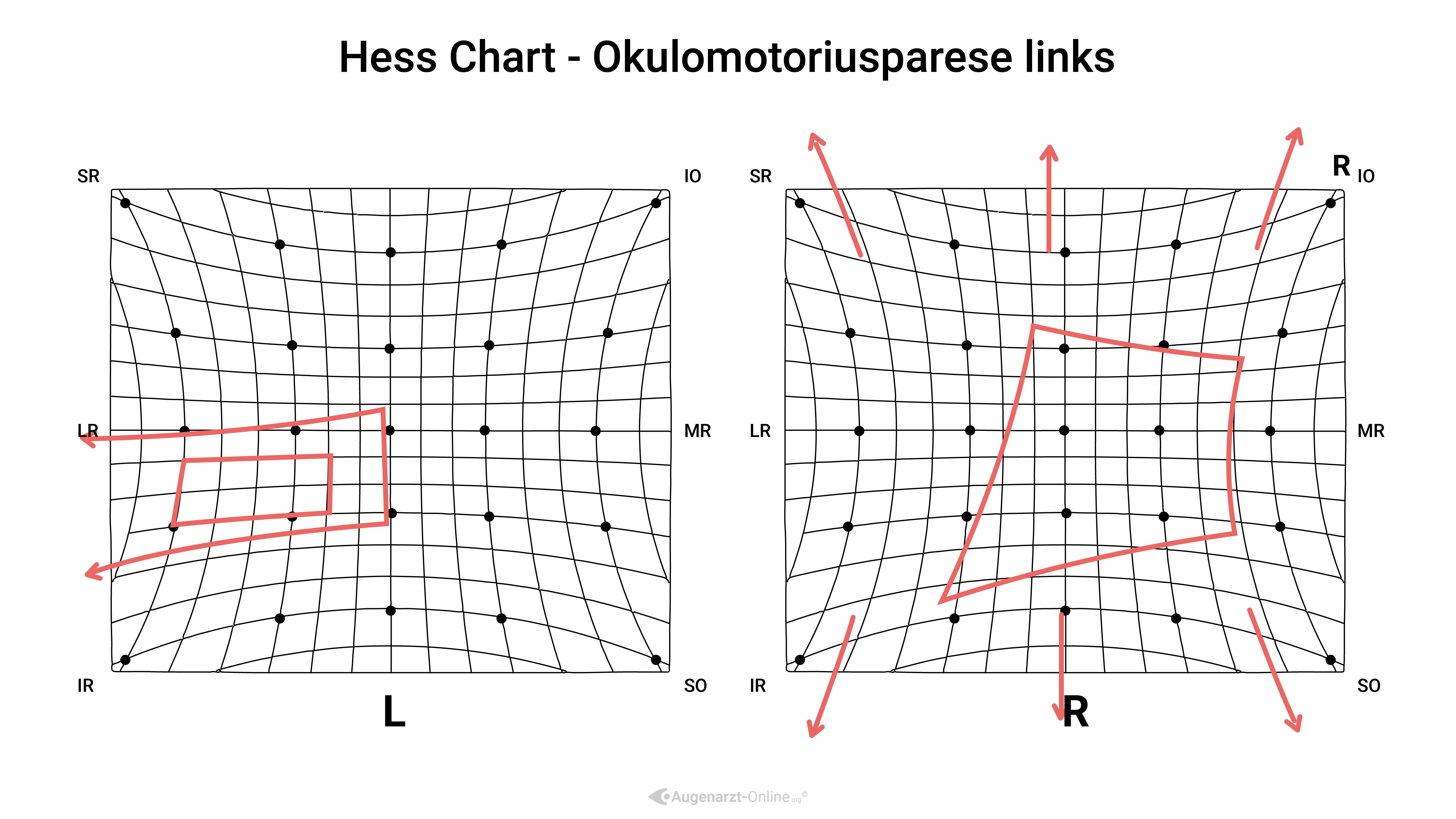 Hess Diagramm - Okulomotoriusparese