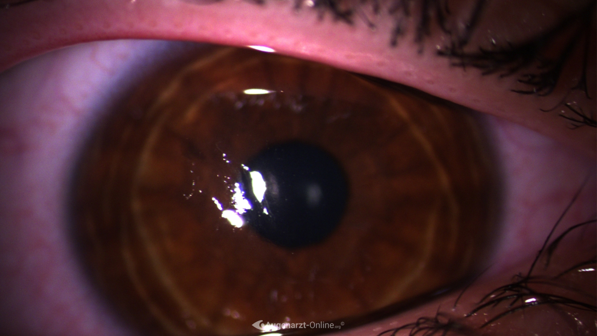 Erosio cornea
