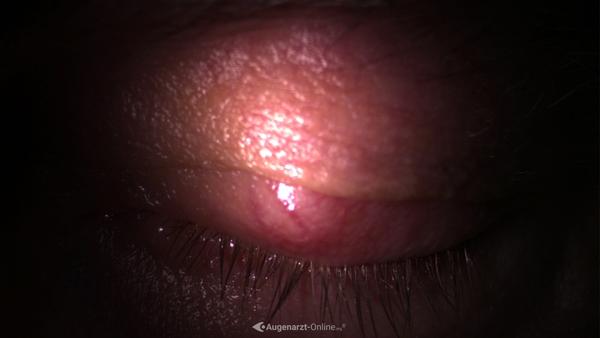Chalazion