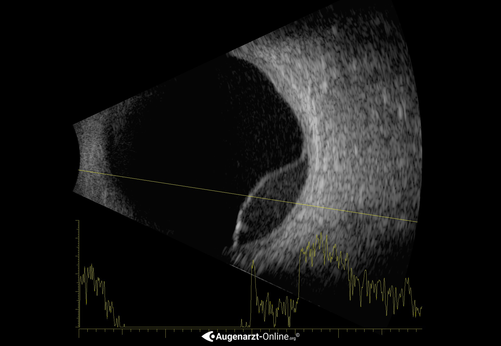 Ablatio retinae