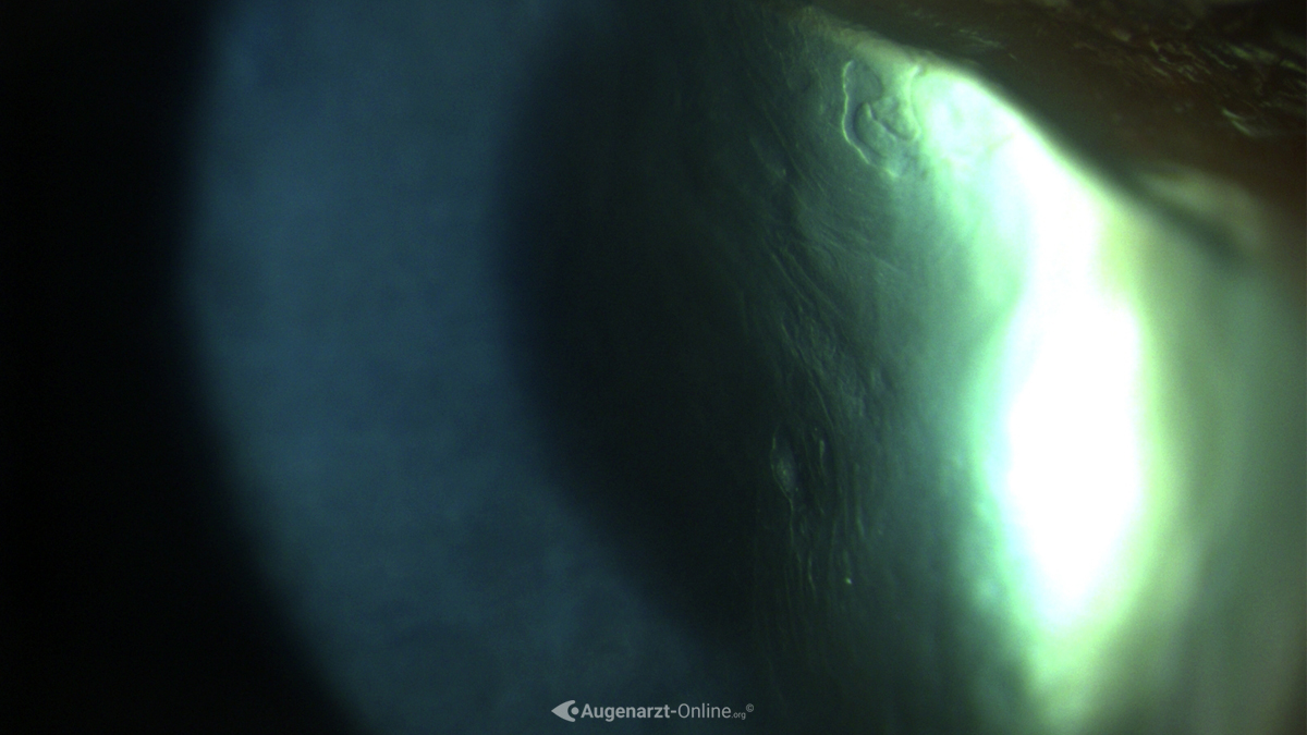Epitheliale Basalmembrandystrophie