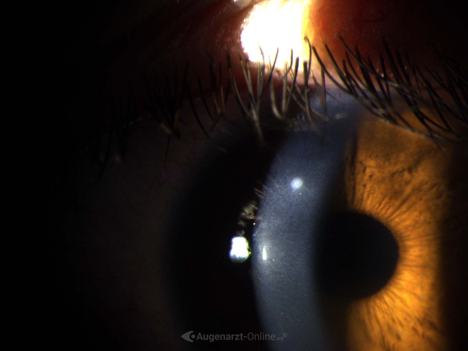 Spaltlampenfoto links zu Hornhautinfiltrat bei Keratitis.