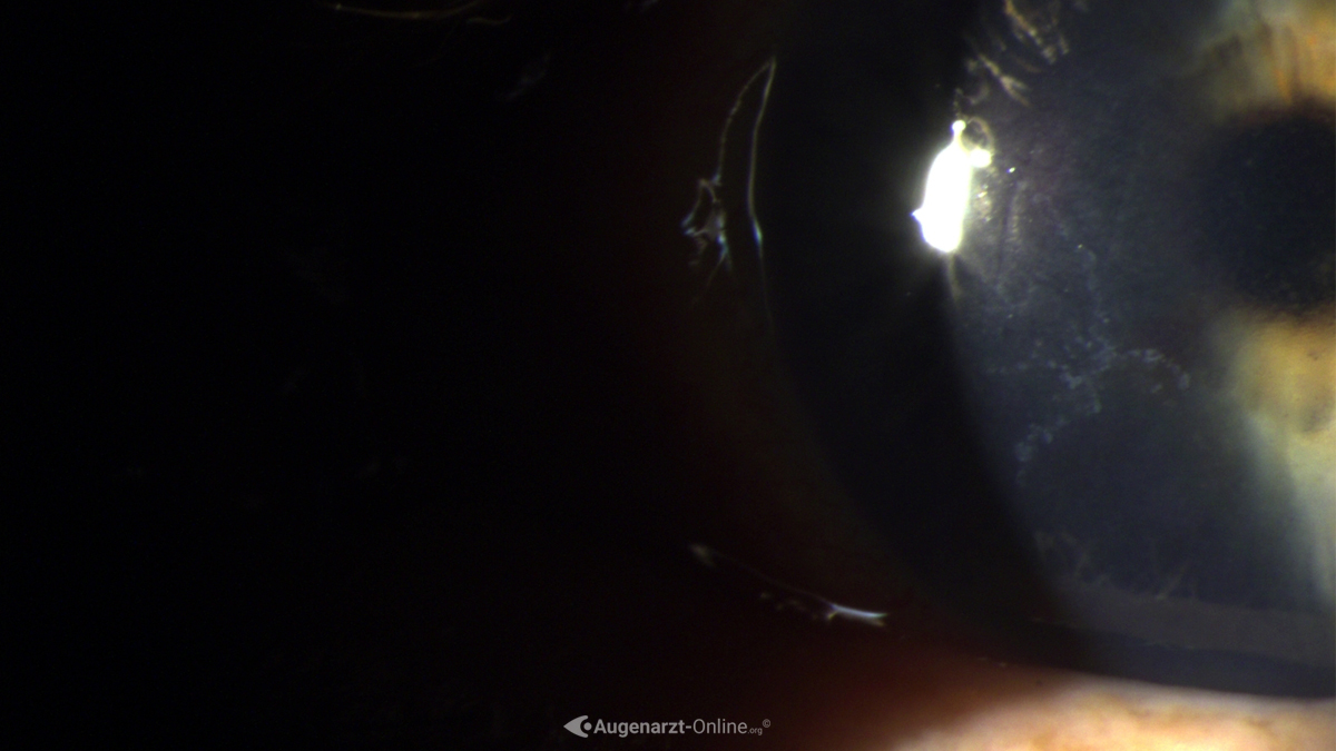 Dentritica bei Herpes Keratitis