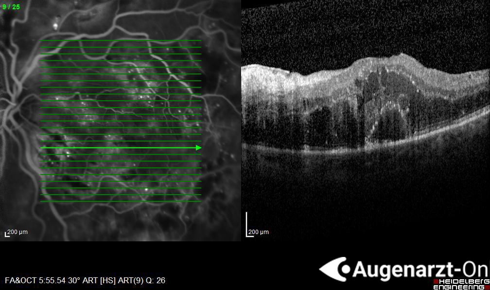 Diabetische Retinopathie
