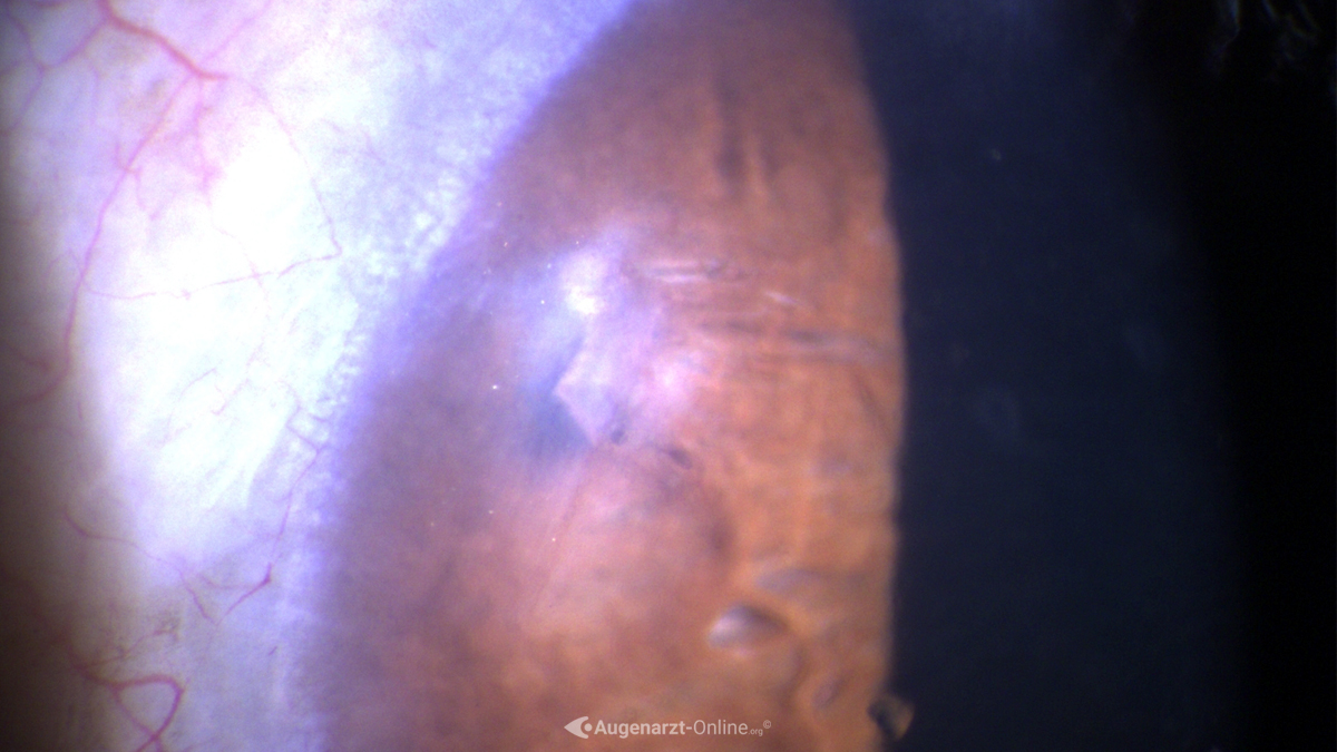 Anteriore Synechie